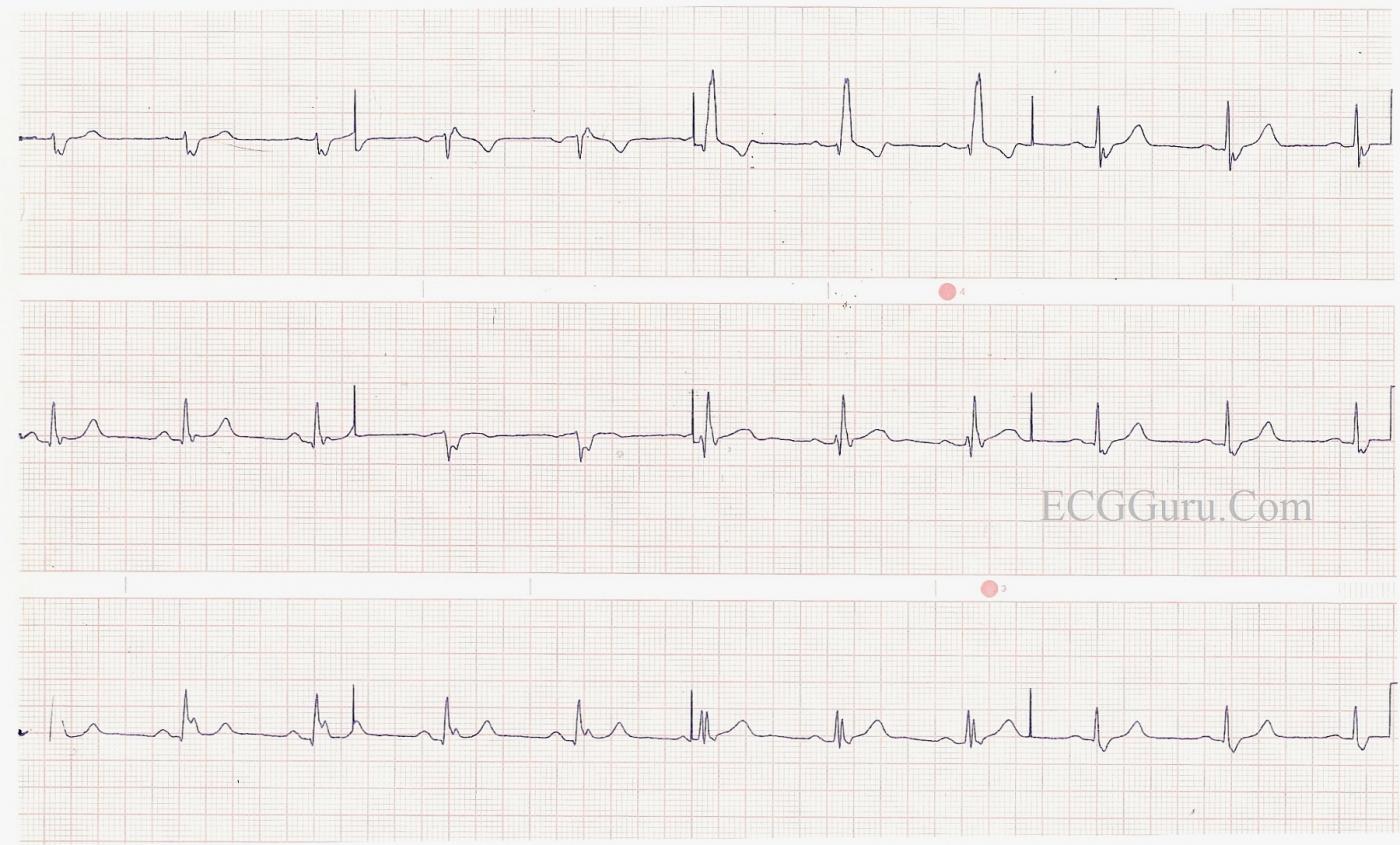 Right Bundle Branch Block With Left Posterior Fascicular Block ECG